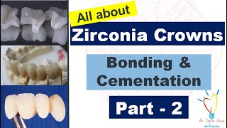 Zirconia Crowns  CEMENTATION vs BONDING [upl. by Idnic]