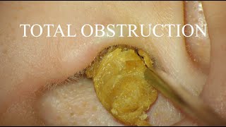 TOTAL OBSTRUCTION  EAR WAX REMOVAL  4KHD [upl. by Irahs72]