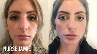 Before and After Micro Needling  Nurse Jamie [upl. by Auohp]