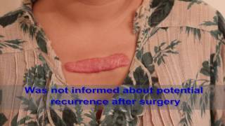 Chest Keloids  Mistakes to Avoid [upl. by Nitsa460]