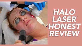 My Halo Laser Experience Honest Review Recovery and Before amp Afters [upl. by Halliday175]