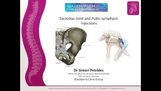 Sacroiliac Joint Injections and prolotherapy [upl. by Vowel]